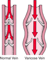 Varicose Veins